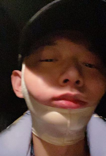 男星打哈欠致下巴脫臼!半夜找醫生掰回來,眼角泛淚骨頭咯咯響