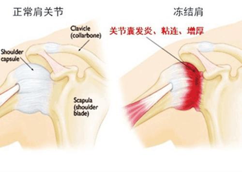 为什么有的人患了肩周炎自己就锻炼好了？而我却要去医院？