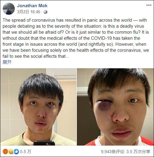 新加坡学生因病毒在伦敦街头被4人围殴 面部骨折需整形手术