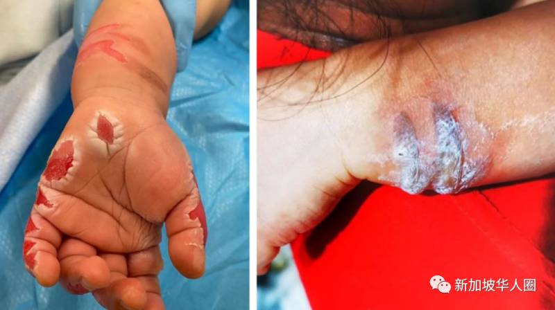 新加坡17个月宝宝手被女佣放锅里煮，皮开肉绽！判坐牢14个月