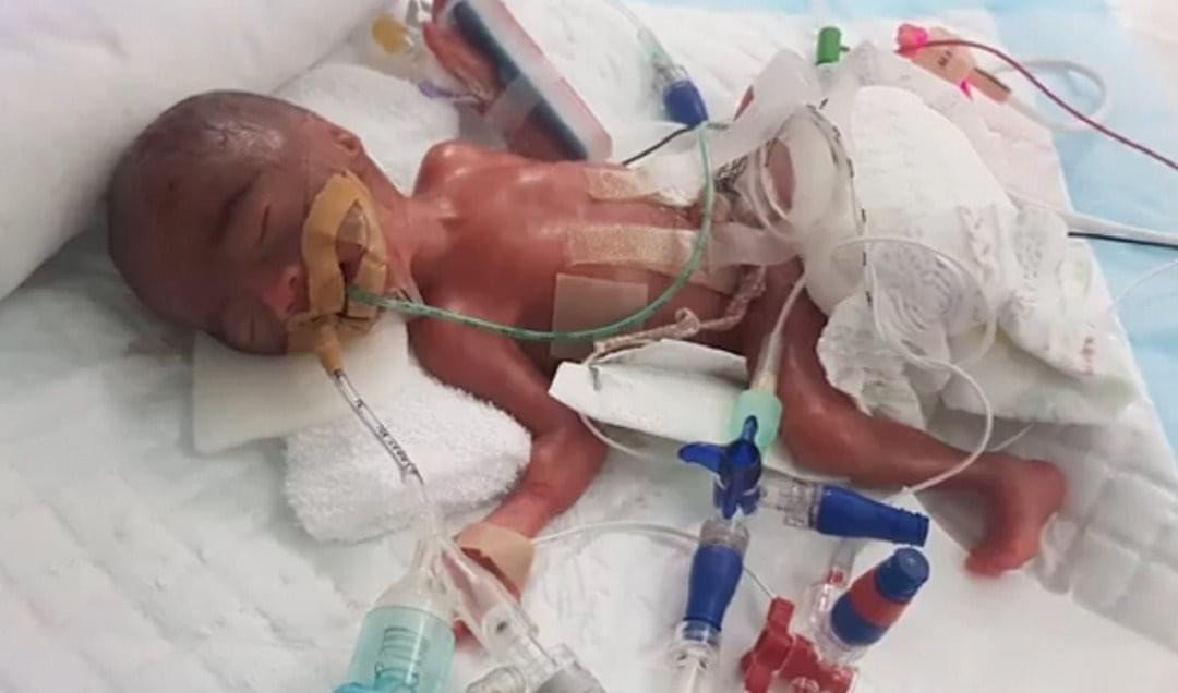 新国体重最轻早产儿 女宝宝出生只有345克