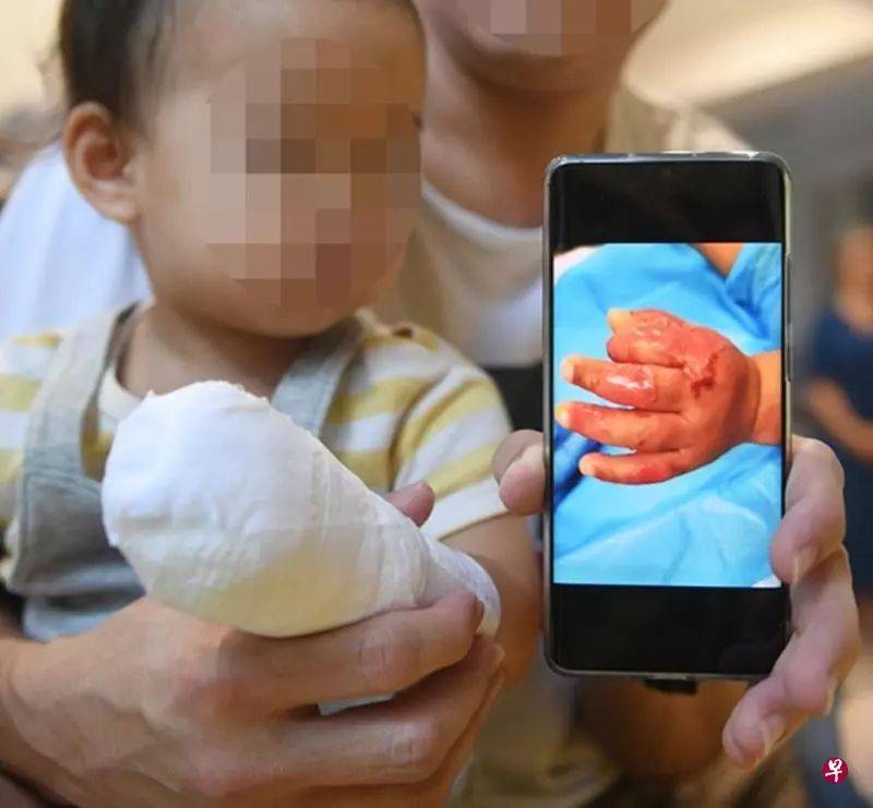 新加坡17个月宝宝手被女佣放锅里煮，皮开肉绽！判坐牢14个月