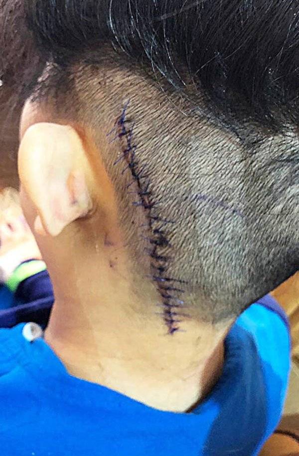 切脑瘤失听力 她坚持承传外婆手艺