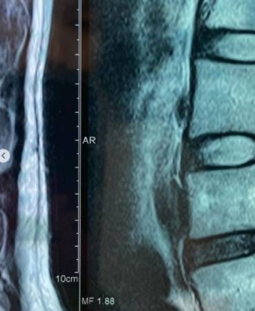 雅慧背伤严重 寸步难移躺床休养 控制不住掉泪
