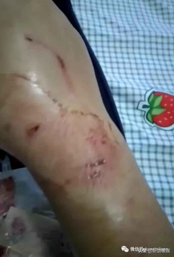 鲜血直流！新加坡女佣被狗咬伤，雇主拖了2天才送医