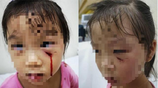 新加坡孔雀啄傷女童事件細節流出，傷口三公分、後院全是禽類