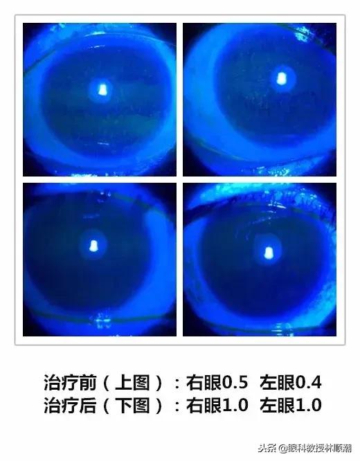 干眼：出现3种情况需要引起重视 出现5种情况需尽快就医！