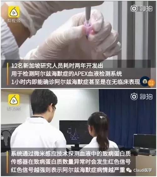 阿尔茨海默症1小时内可确诊：新加坡血液测试技术预计5年问世