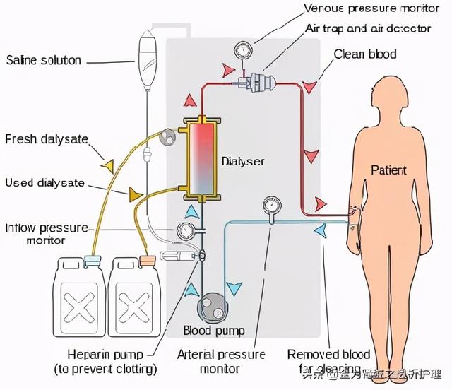 「转」记血透装置的诞生和发展（下）