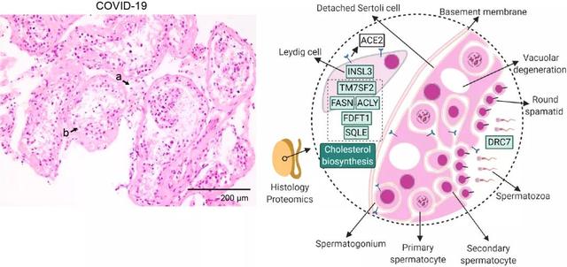 首张新冠患者器官分子病理全景图，死亡患者睾丸组织蛋白明显改变