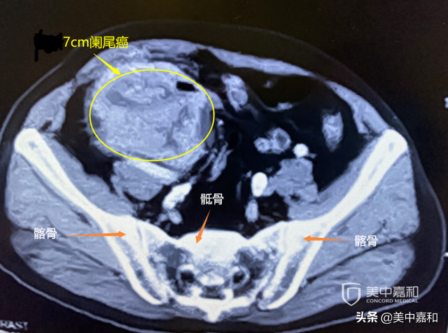 男子患了“女神癌”，术后如何防复发？