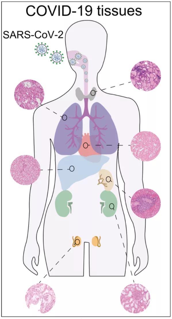 首张新冠患者器官分子病理全景图，死亡患者睾丸组织蛋白明显改变