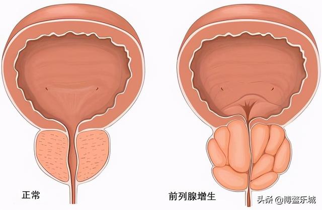 男人，要懂得爱自己，前列腺增生，你又知道多少？