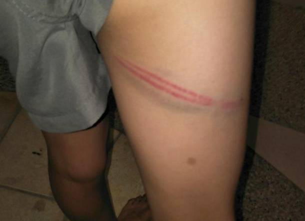 新加坡鞭刑后疤痕图片